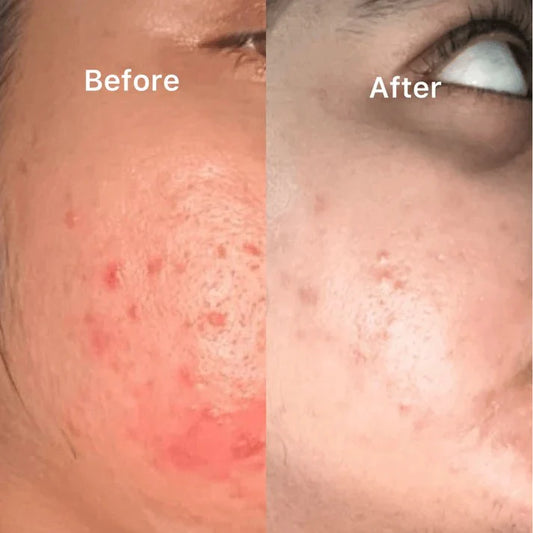 Vitamin C & E Serum (Anti Acne+Anti-Aging+Anti-Hyperpigmentation)